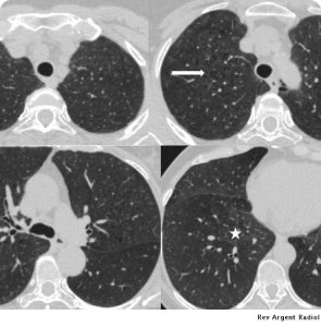 TOMOGRAFIA DE PULMON